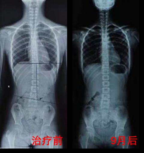 # 如何用AI让本地患者主动找上门：脊柱侧弯支具定制老板的3步躺赚指南